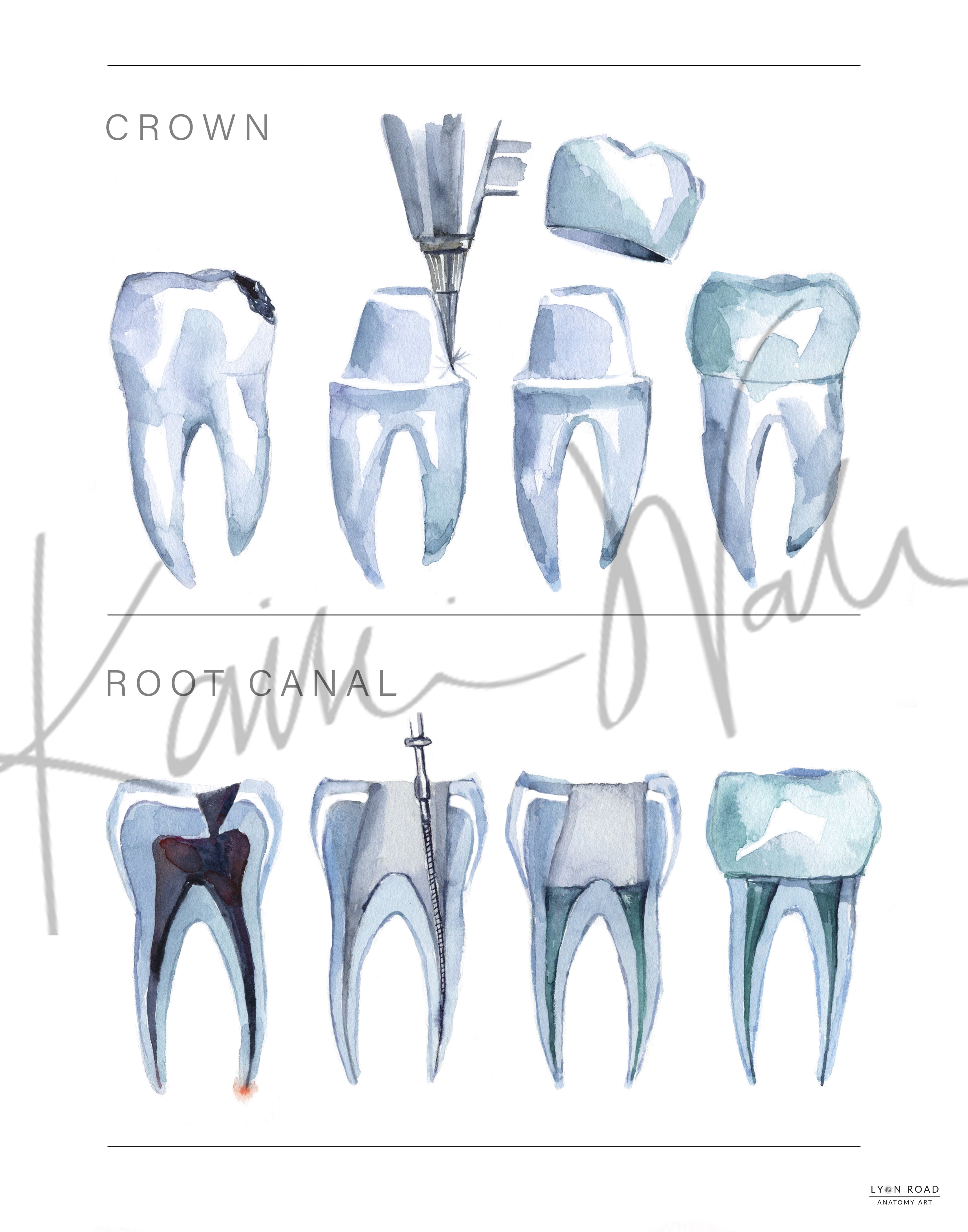 Crown & Root Canal Dental Diagram