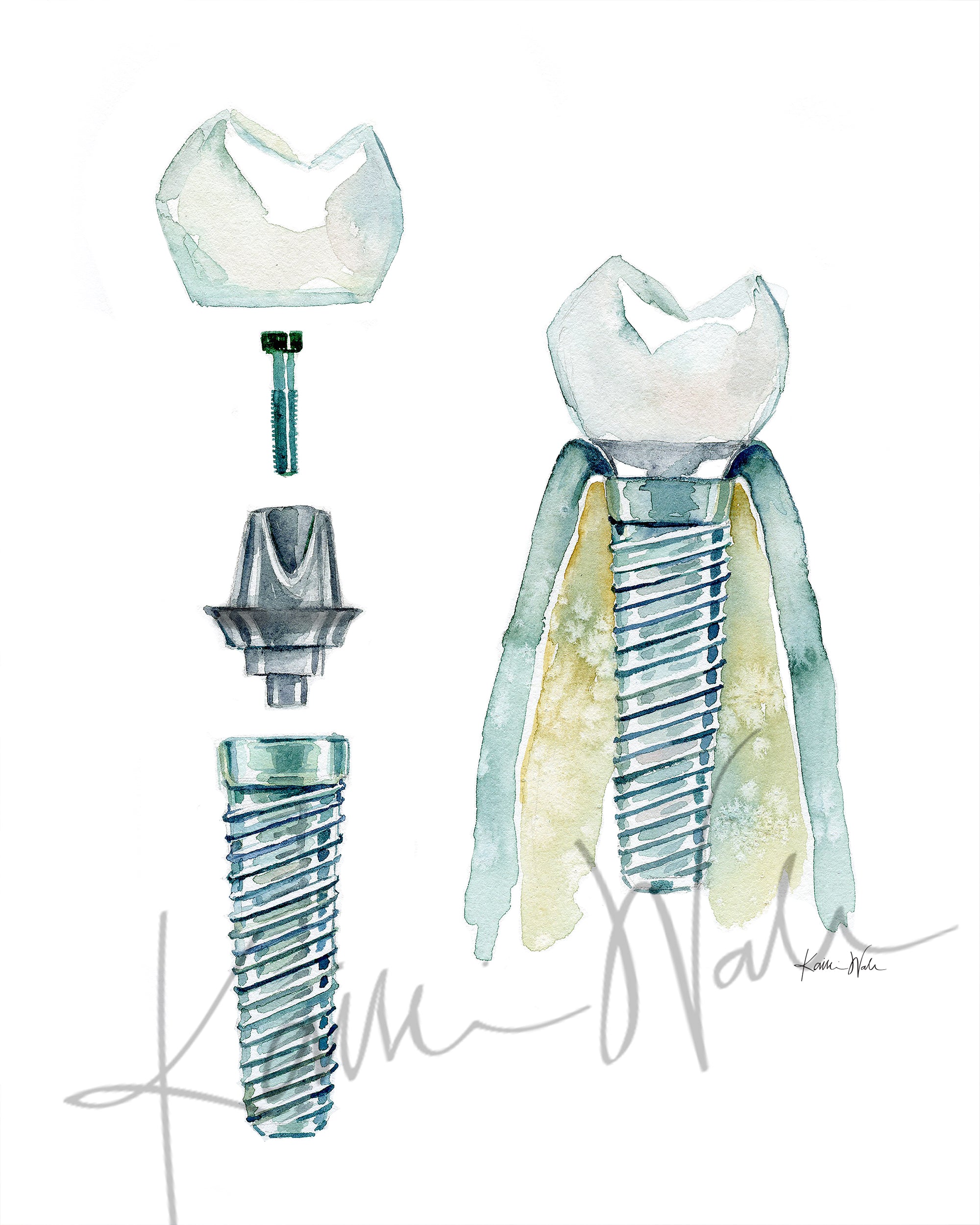 Dental Implant Watercolor Print - Lyon Road Art