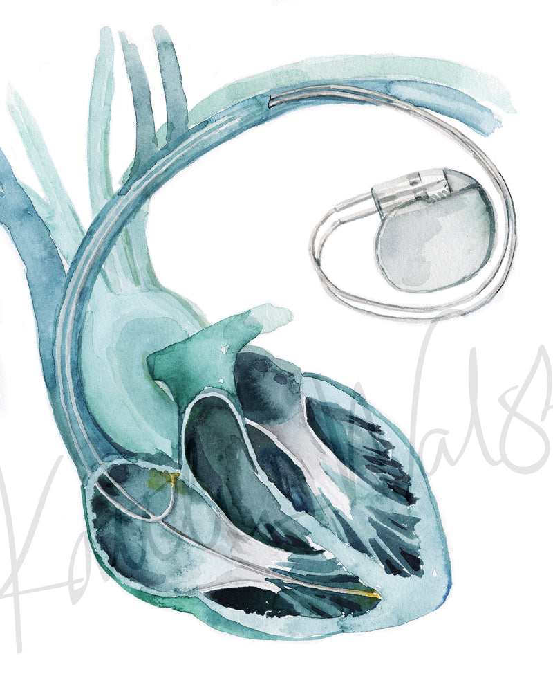 Artistic anatomy art of a blue and green anatomical heart with a with a silver pacemaker.