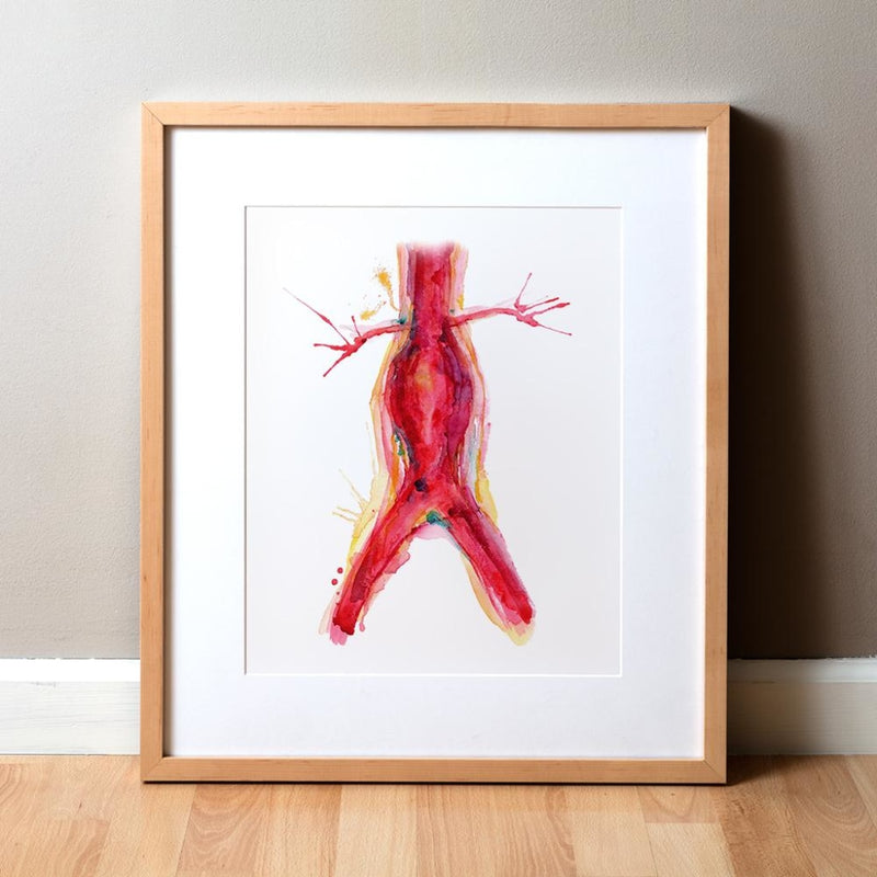 Abdominal Aneurysm Print Watercolor in Red and yellows-  Cardiovascular art- Anatomy Art- Heart