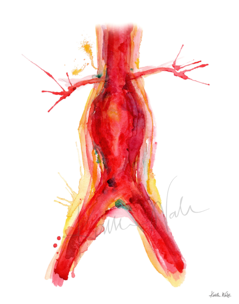 Abdominal Aneurysm Print Watercolor- Medical Art- Artery Art- Medical Condition- Gift for Patient- Gift for Doctor