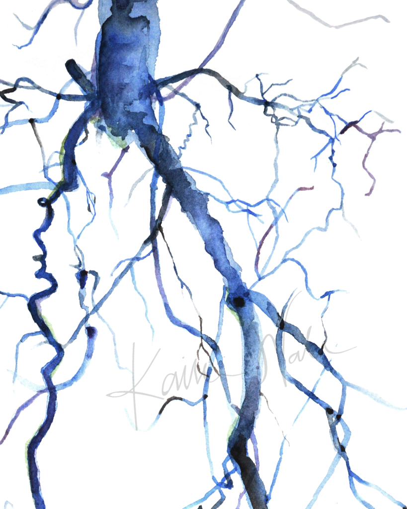 Aorta Angiogram Print Watercolor- Quality Watercolor Art- descending aorta-  common iliac arteries in blue- Gift for Doctor