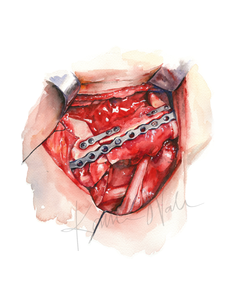 Neck Dissection I Print Watercolor- anatomy art- surgery art- head surgery- neck srugery- neck cancer