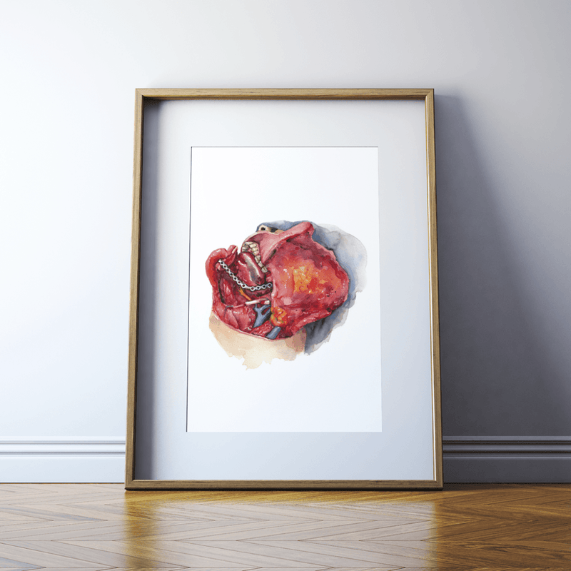 Neck Dissection Print Watercolor- surgery art- anatomy art- gift for doctor- gift for medical student- cancer surgery